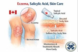 Eczema and salicylic acid treatment